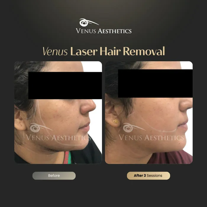 Laser hair removal before and after photo of an actual Venus Aesthetics client, 3 of 17