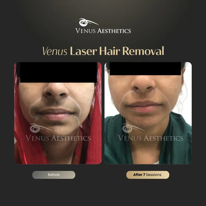 Laser hair removal before and after photo of an actual Venus Aesthetics client, 4 of 17