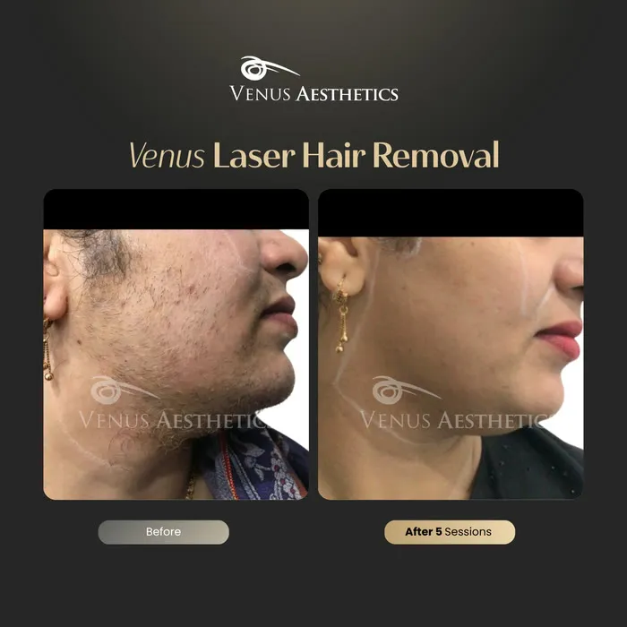 Laser hair removal before and after photo of an actual Venus Aesthetics client, 5 of 17
