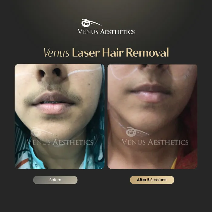 Laser hair removal before and after result at Venus Aesthetics