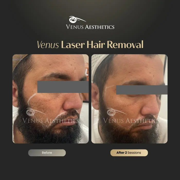 Laser hair removal before and after result at Venus Aesthetics