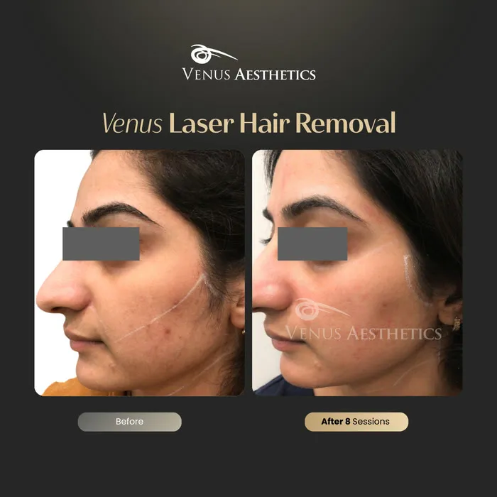 Laser hair removal before and after photo of an actual Venus Aesthetics client, 8 of 17