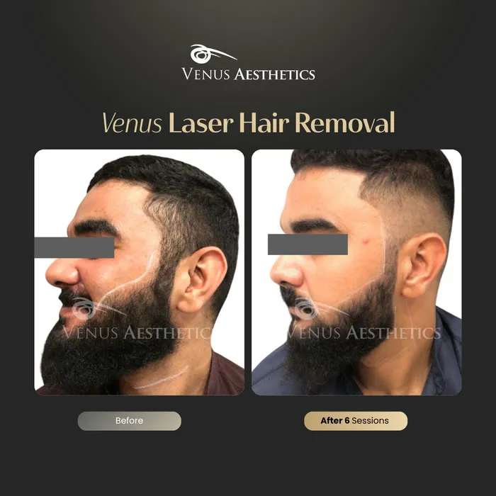 Laser hair removal before and after photo of an actual Venus Aesthetics client, 9 of 17