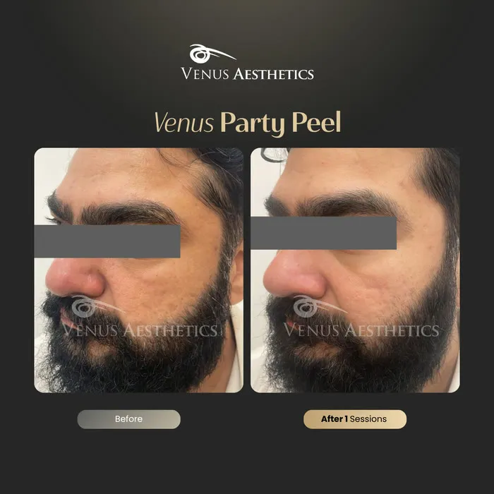 Party Peel brightening peel before and after photo of an actual Venus Aesthetics client, 1 of 6