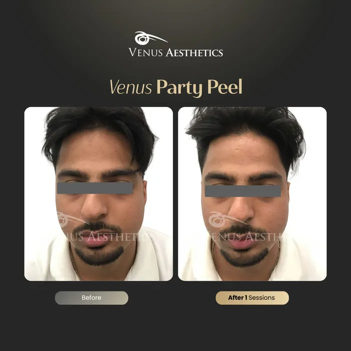 Party peel before and after result at Venus Aesthetics