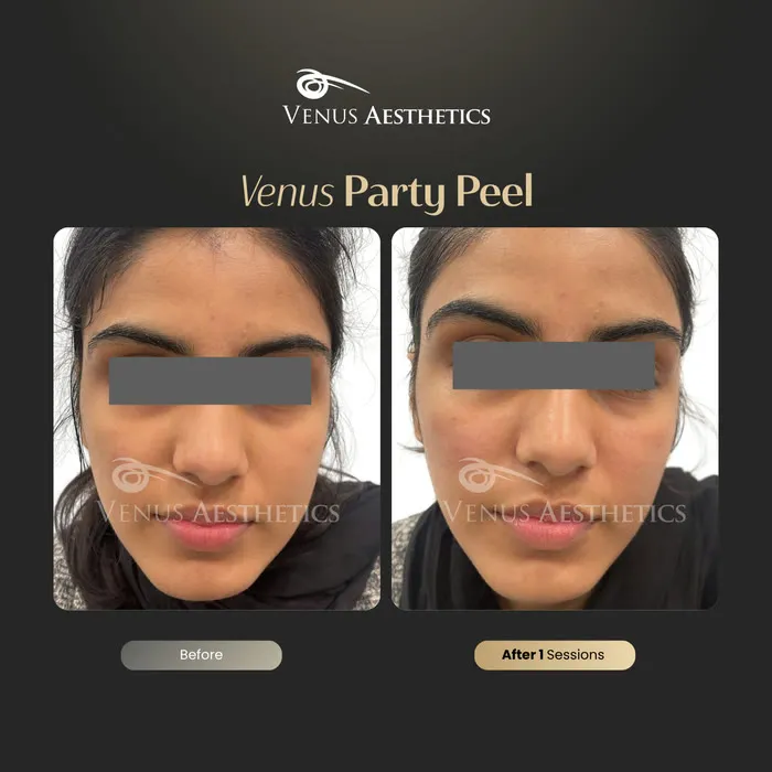 Party peel before and after result at Venus Aesthetics