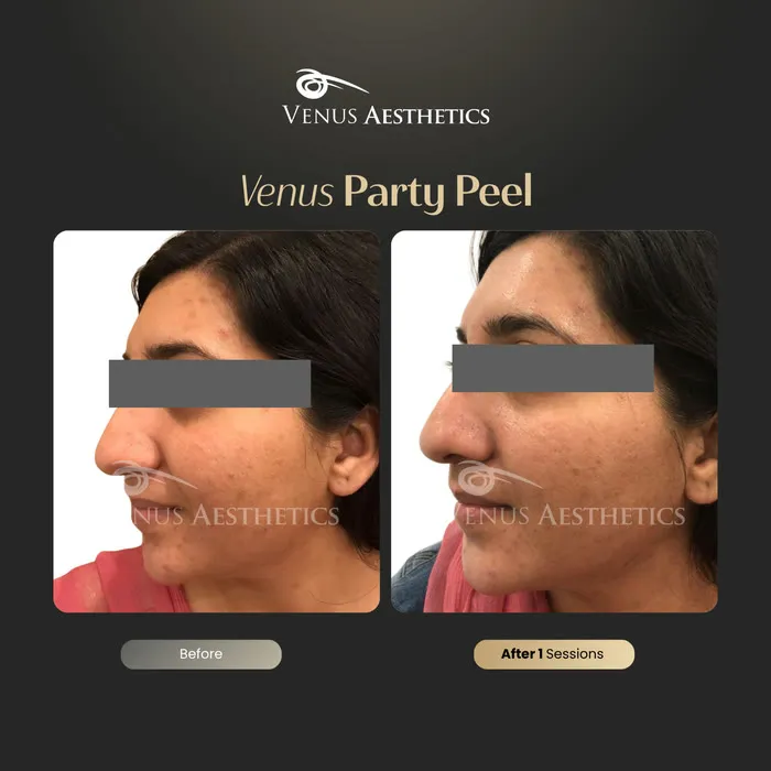 Party Peel brightening peel before and after photo of an actual Venus Aesthetics client, 4 of 6
