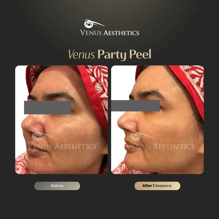Party peel before and after result at Venus Aesthetics