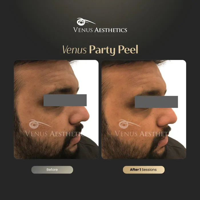 Party Peel brightening peel before and after photo of an actual Venus Aesthetics client, 6 of 6