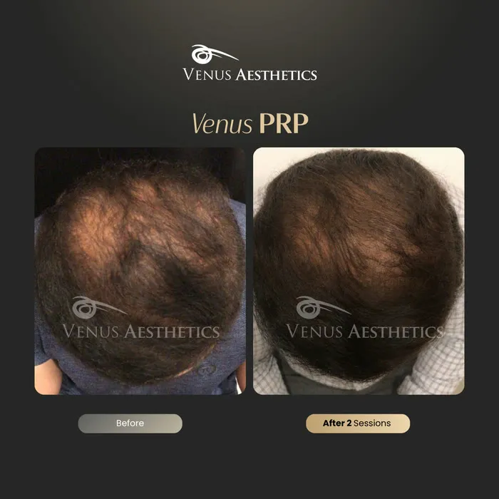 PRP hair restoration before and after result at Venus Aesthetics