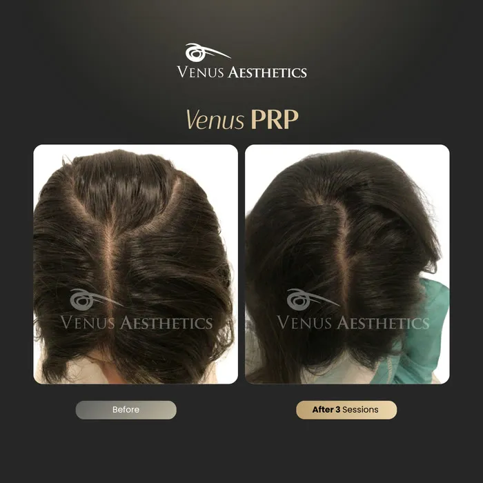 PRP hair restoration before and after result at Venus Aesthetics