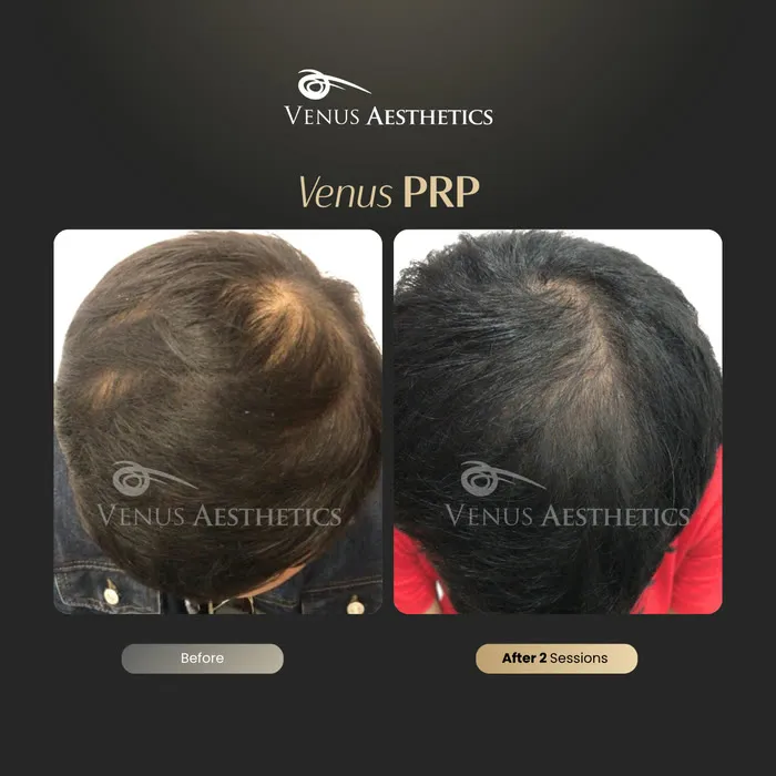 Venus PRP hair treatment before and after photo of an actual Venus Aesthetics client, 11 of 16