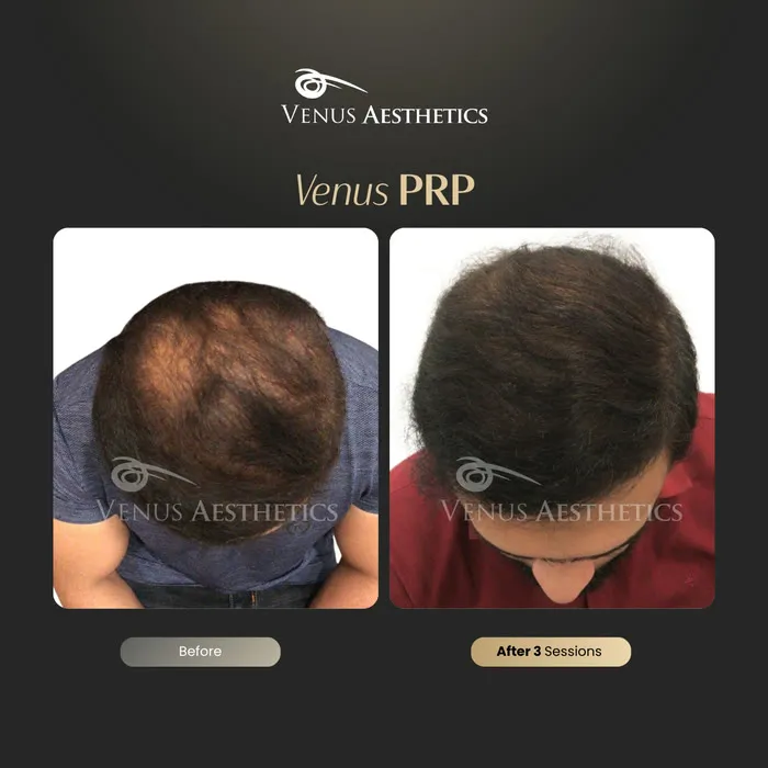 Venus PRP hair treatment before and after photo of an actual Venus Aesthetics client, 12 of 16