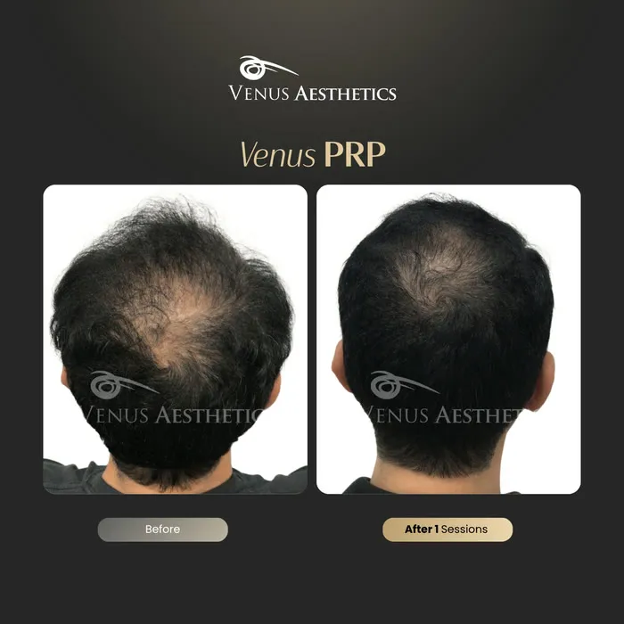 Venus PRP hair treatment before and after photo of an actual Venus Aesthetics client, 13 of 16
