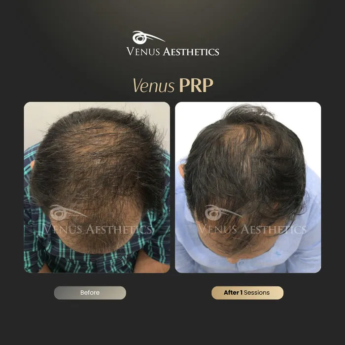 Venus PRP hair treatment before and after photo of an actual Venus Aesthetics client, 14 of 16