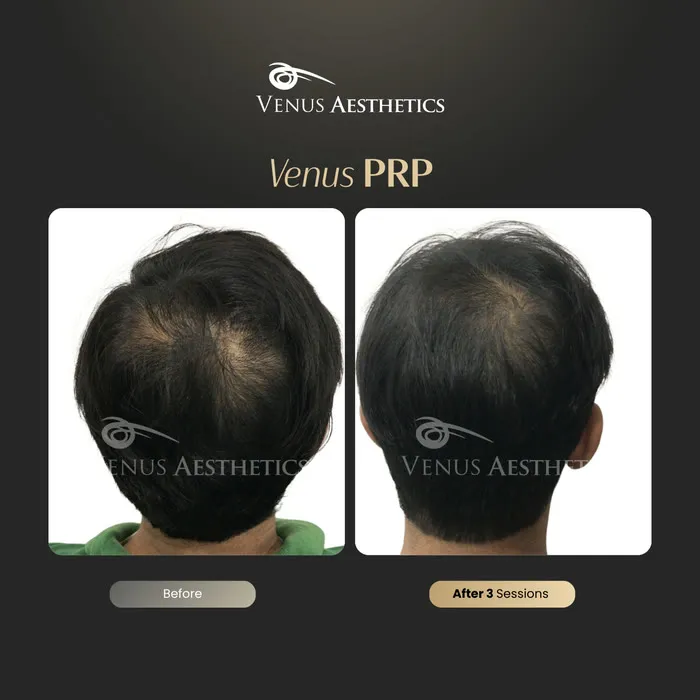Venus PRP hair treatment before and after photo of an actual Venus Aesthetics client, 15 of 16