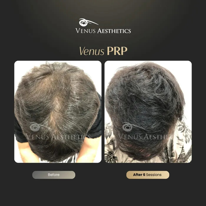 PRP hair restoration before and after result at Venus Aesthetics