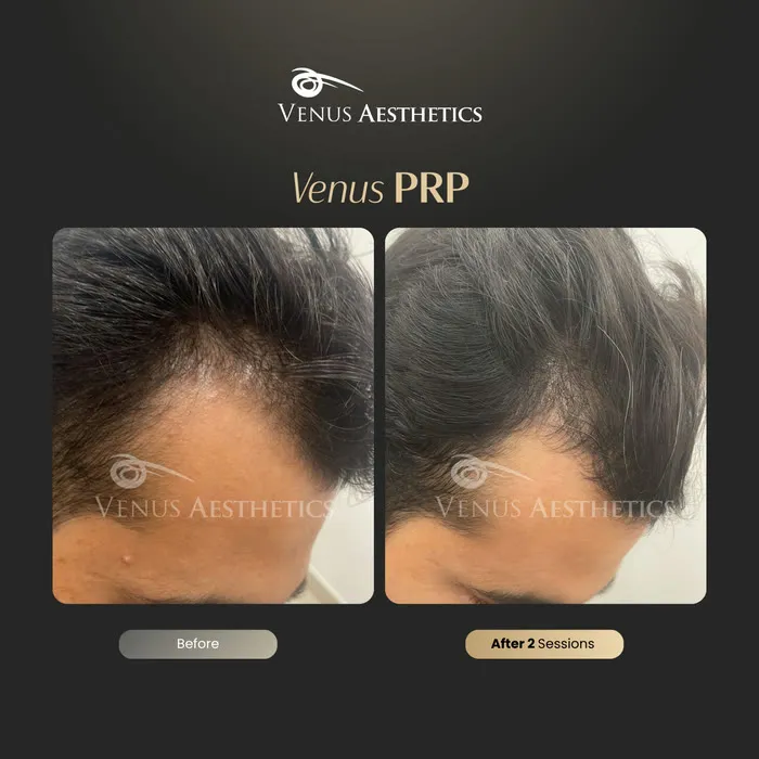 PRP hair restoration before and after result at Venus Aesthetics