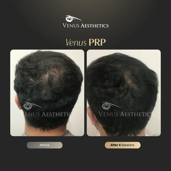 PRP hair restoration before and after result at Venus Aesthetics