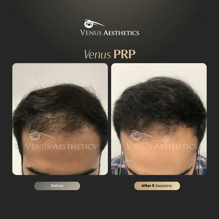 Venus PRP hair treatment before and after photo of an actual Venus Aesthetics client, 4 of 16