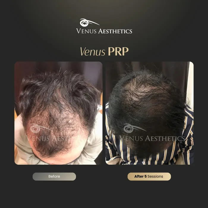 Venus PRP hair treatment before and after photo of an actual Venus Aesthetics client, 5 of 16