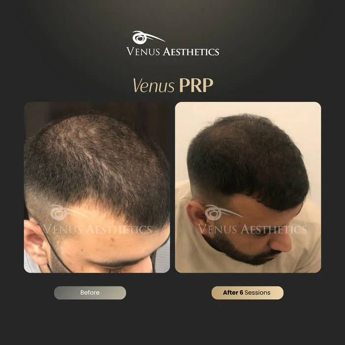 PRP hair restoration before and after result at Venus Aesthetics