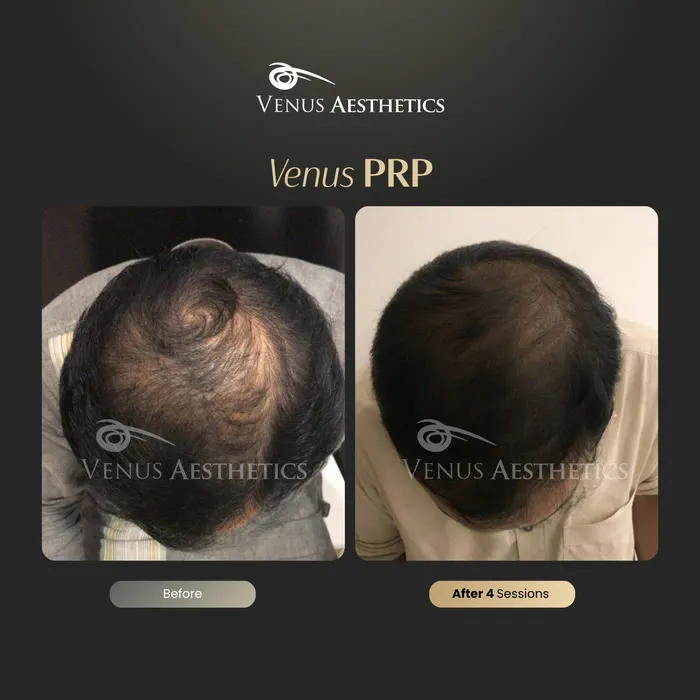 Venus PRP hair treatment before and after photo of an actual Venus Aesthetics client, 7 of 16