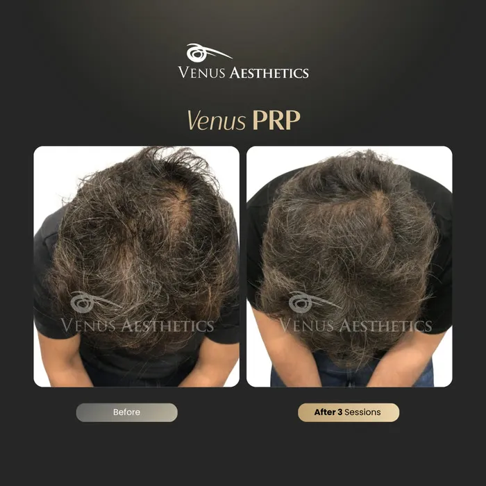 Venus PRP hair treatment before and after photo of an actual Venus Aesthetics client, 9 of 16