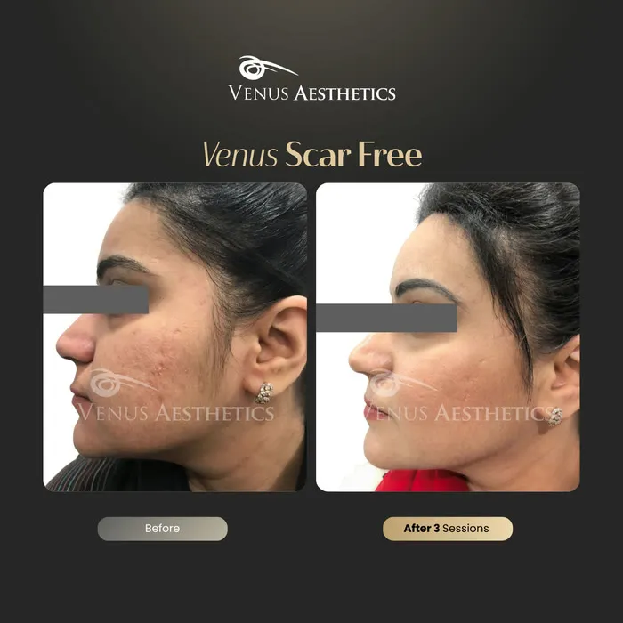 Venus Scar Free scar treatment before and after photo of an actual Venus Aesthetics client, 1 of 13