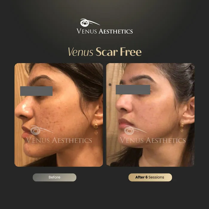 Venus Scar Free scar treatment before and after photo of an actual Venus Aesthetics client, 10 of 13