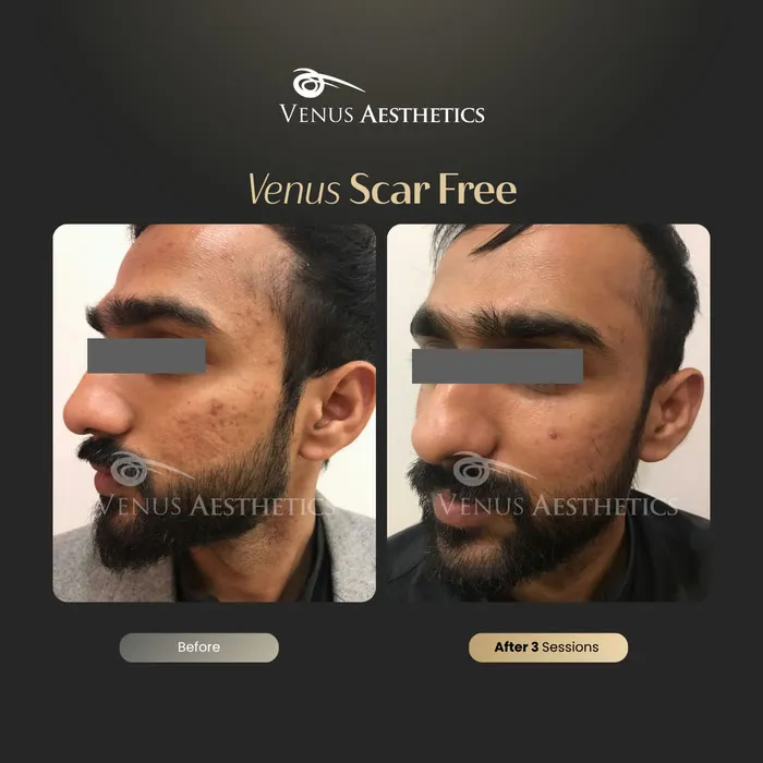 Venus Scar Free scar treatment before and after photo of an actual Venus Aesthetics client, 11 of 13