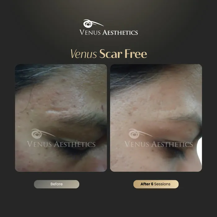 Venus Scar Free scar treatment before and after photo of an actual Venus Aesthetics client, 12 of 13