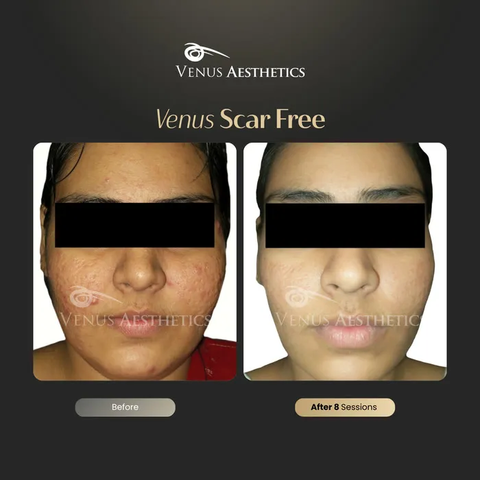 Venus Scar Free scar treatment before and after photo of an actual Venus Aesthetics client, 13 of 13
