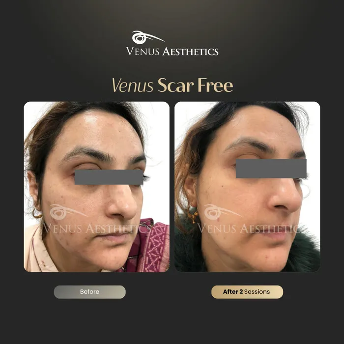 Venus Scar Free scar treatment before and after photo of an actual Venus Aesthetics client, 2 of 13