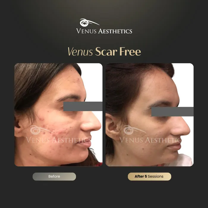 Venus Scar Free scar treatment before and after photo of an actual Venus Aesthetics client, 3 of 13
