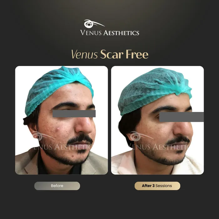 Scar removal before and after result at Venus Aesthetics