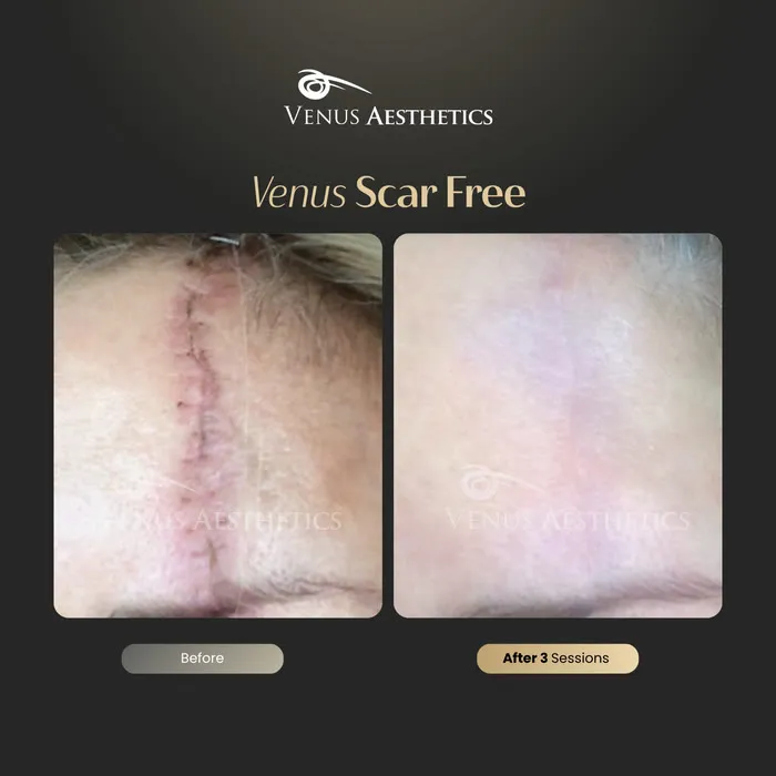Venus Scar Free scar treatment before and after photo of an actual Venus Aesthetics client, 5 of 13
