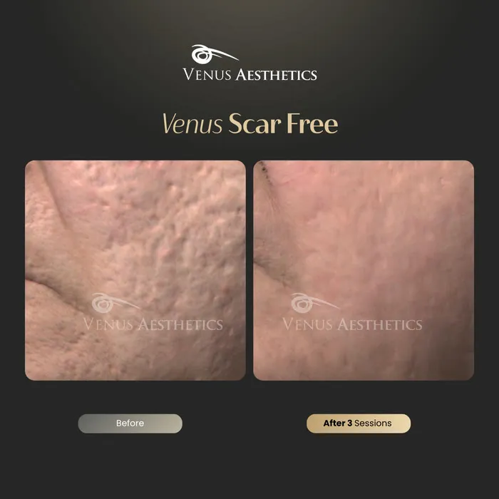 Venus Scar Free scar treatment before and after photo of an actual Venus Aesthetics client, 6 of 13