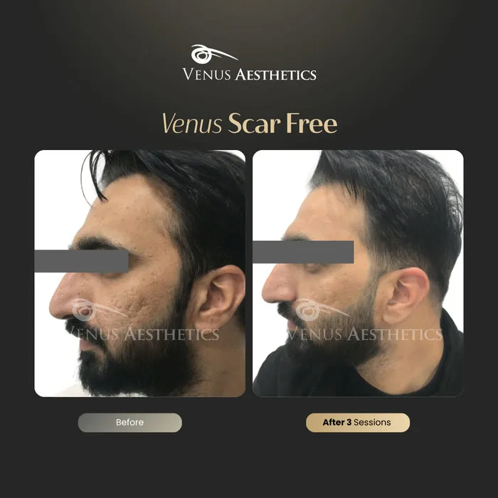 Venus Scar Free scar treatment before and after photo of an actual Venus Aesthetics client, 7 of 13