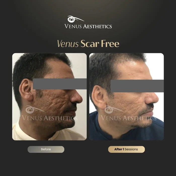 Scar removal before and after result at Venus Aesthetics
