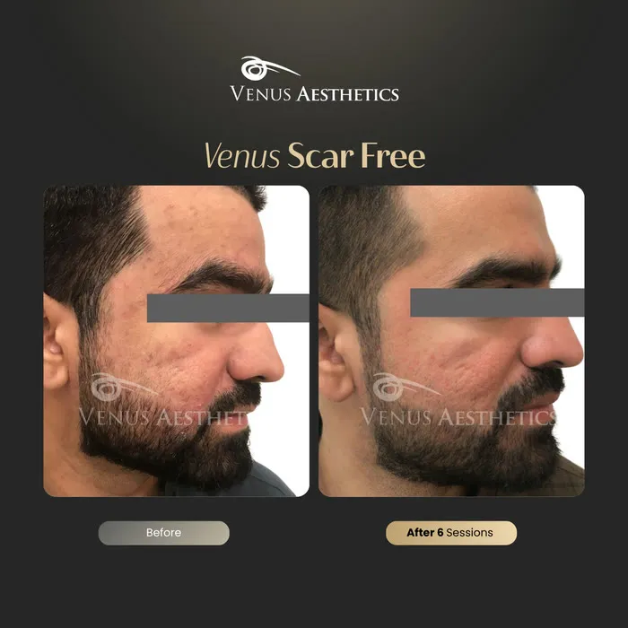 Venus Scar Free scar treatment before and after photo of an actual Venus Aesthetics client, 9 of 13
