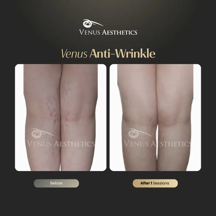 Venus Stretch Mark Treatment before and after photo of an actual Venus Aesthetics client, 1 of 2