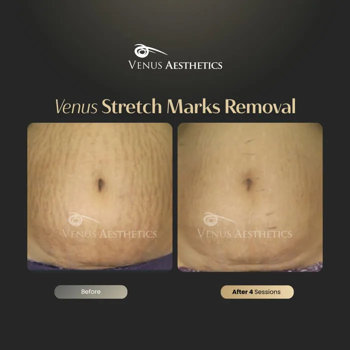 Stretch mark removal before and after result at Venus Aesthetics