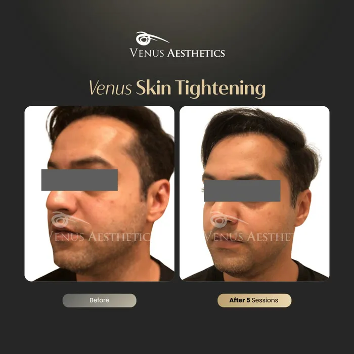 Non-surgical face lift before and after result at Venus Aesthetics