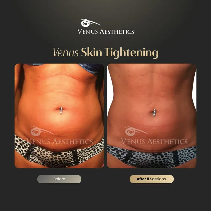 Non-surgical skin tightening and firming before and after photo of an actual Venus Aesthetics client, 10 of 16