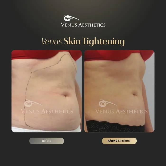 TummyTite skin tightening before and after result at Venus Aesthetics