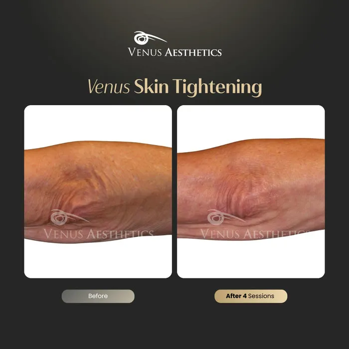 Non-surgical skin tightening and firming before and after photo of an actual Venus Aesthetics client, 12 of 16