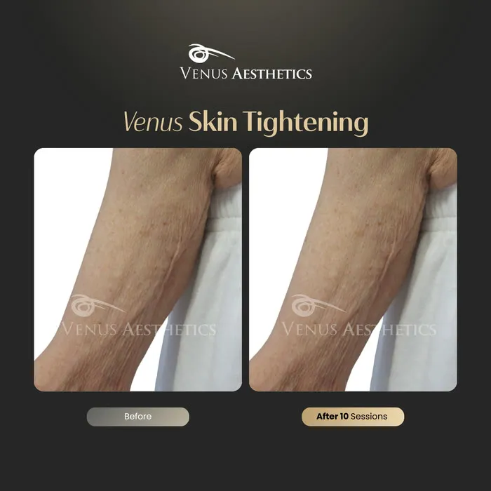 Non-surgical skin tightening and firming before and after photo of an actual Venus Aesthetics client, 13 of 16