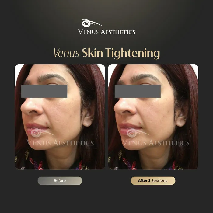 TummyTite skin tightening before and after result at Venus Aesthetics