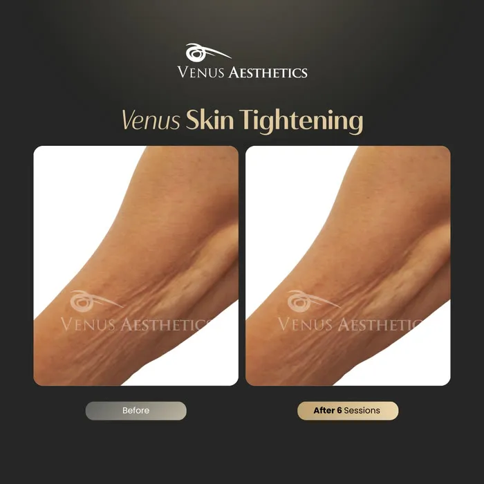 Non-surgical skin tightening and firming before and after photo of an actual Venus Aesthetics client, 15 of 16